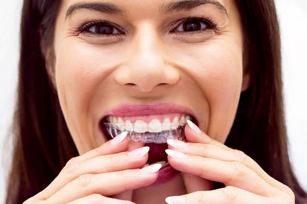 invisalign vigo tratamiento BASTIDA Clínica Dental