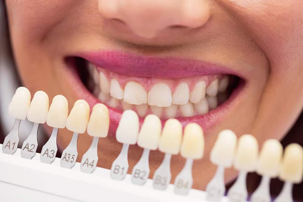 cómo tratar la fluorosis dental carillas