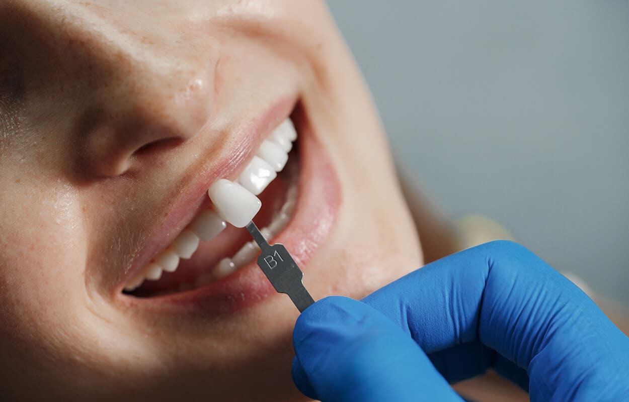eliminar manchas en los dientes carillas dentales