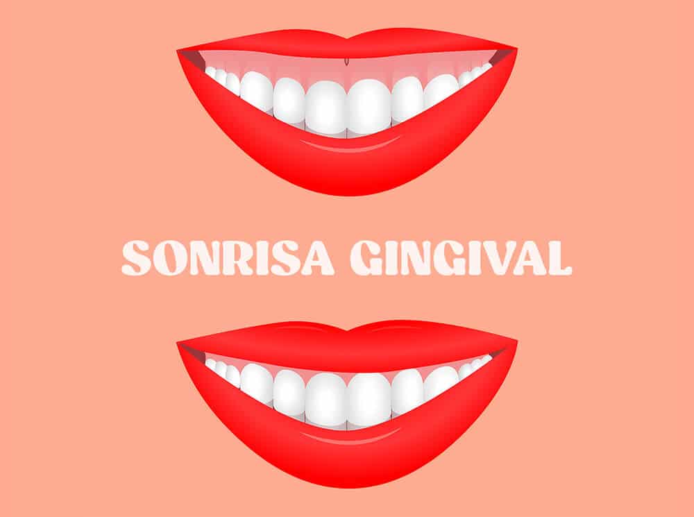 sonrisa gingival ejemplo