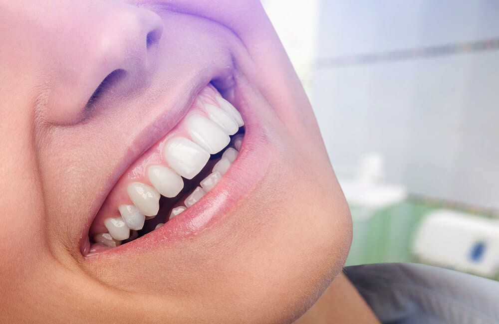 sonrisa gingival gummy smile