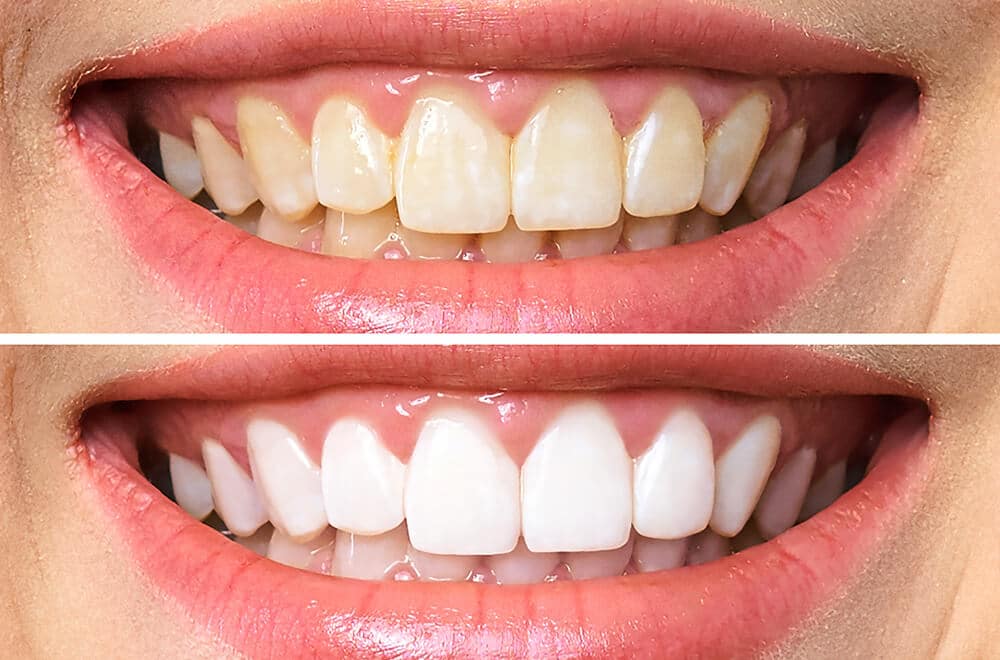 tipos de blanqueamiento dental