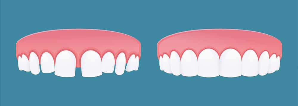 diastema infografía