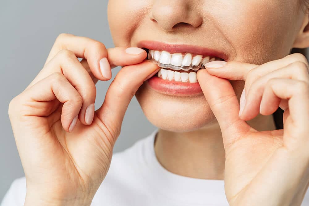 diseño de sonrisa ortodoncia invisible Invisalign