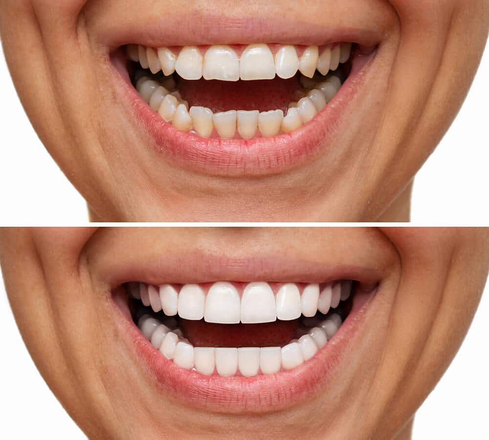cuánto duran las carillas dentales