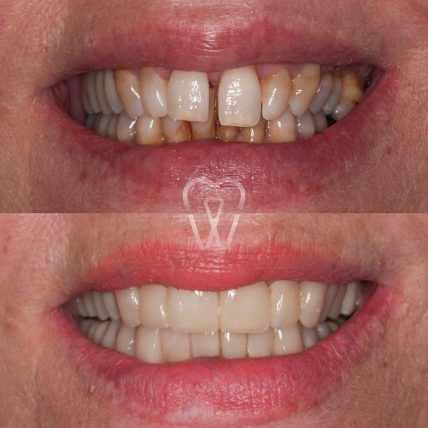 AD-estica-carillas-implantes-ortodoncia-1
