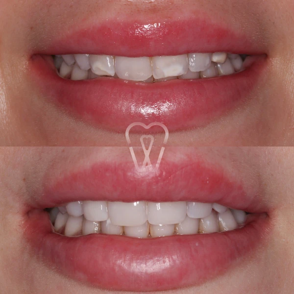 AD-estica-carillas-implantes-ortodoncia-2