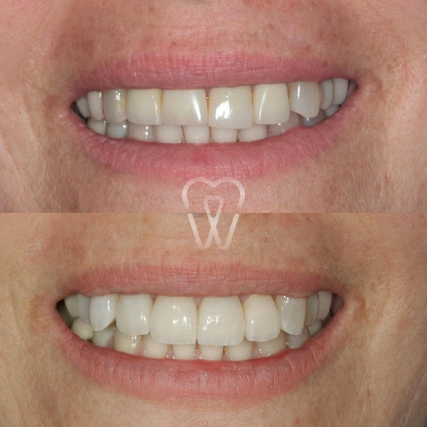 AD-estica-carillas-implantes-ortodoncia