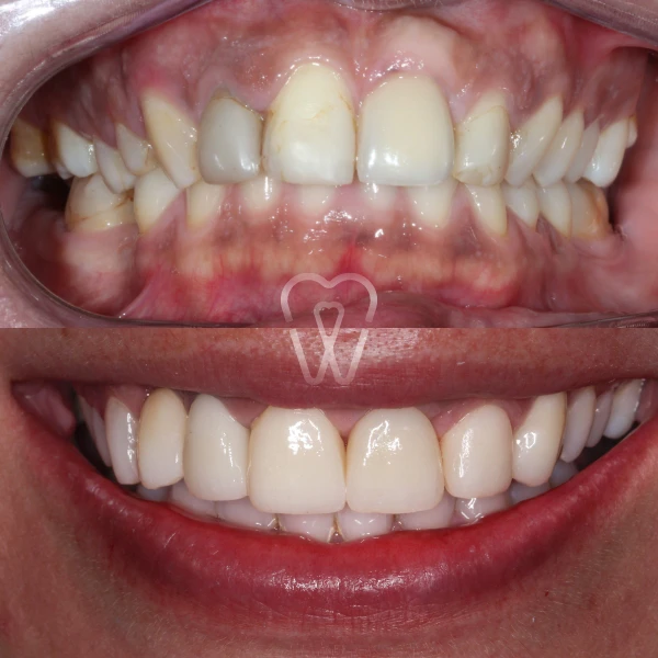 AD-estica-carillas-implantes-ortodoncia